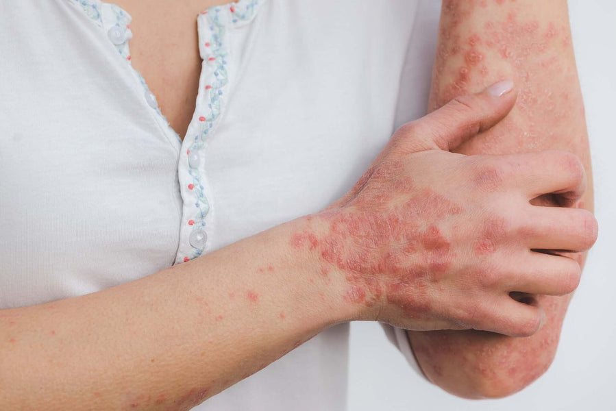 Cos'è la Psoriasi?