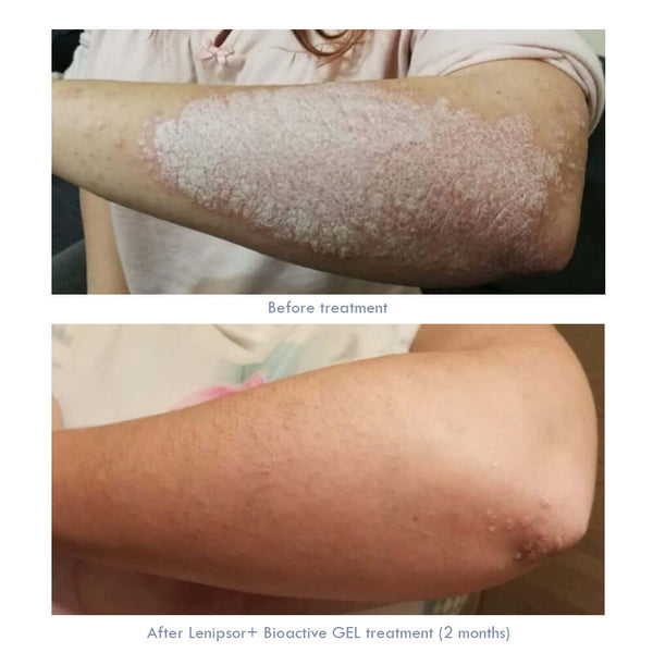 Come viene curata la Psoriasi?