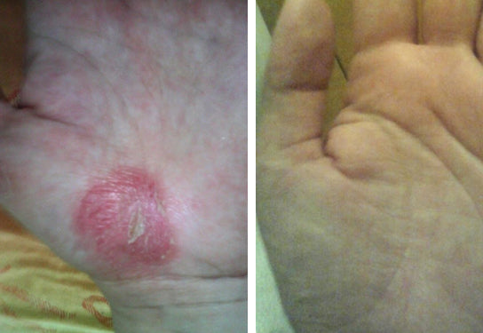 Approfondimento sulla Psoriasi