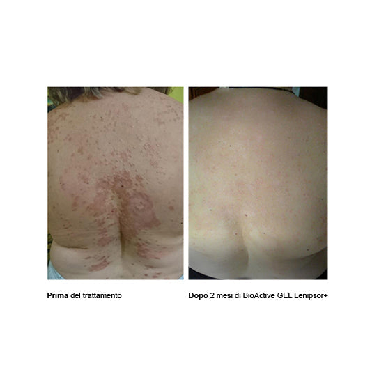 Approfondimento sulle Placche della Psoriasi