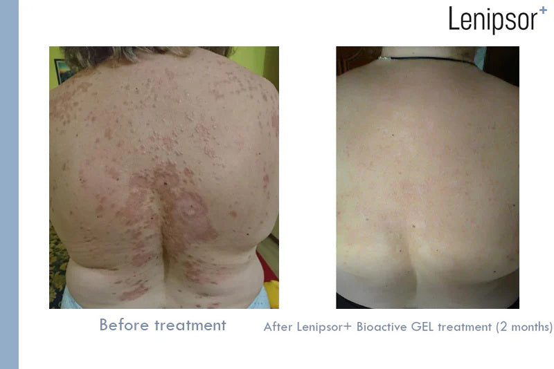 BioActive GEL Lenipsor+® 100 ml
